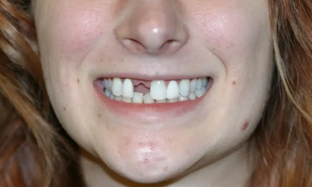 Clinical photo from Hope's smile reconstruction case